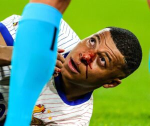 Kylian Mbappe broken nose (PC: Fabrizio Romano)